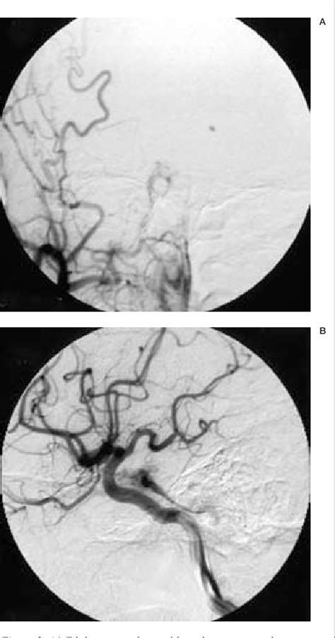 External Manual Carotid Compression is Effective in Patients with 